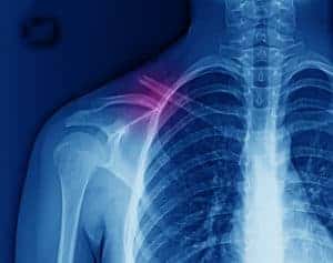 What To Expect When Expecting Shoulder Surgery | AICA Orthopedics