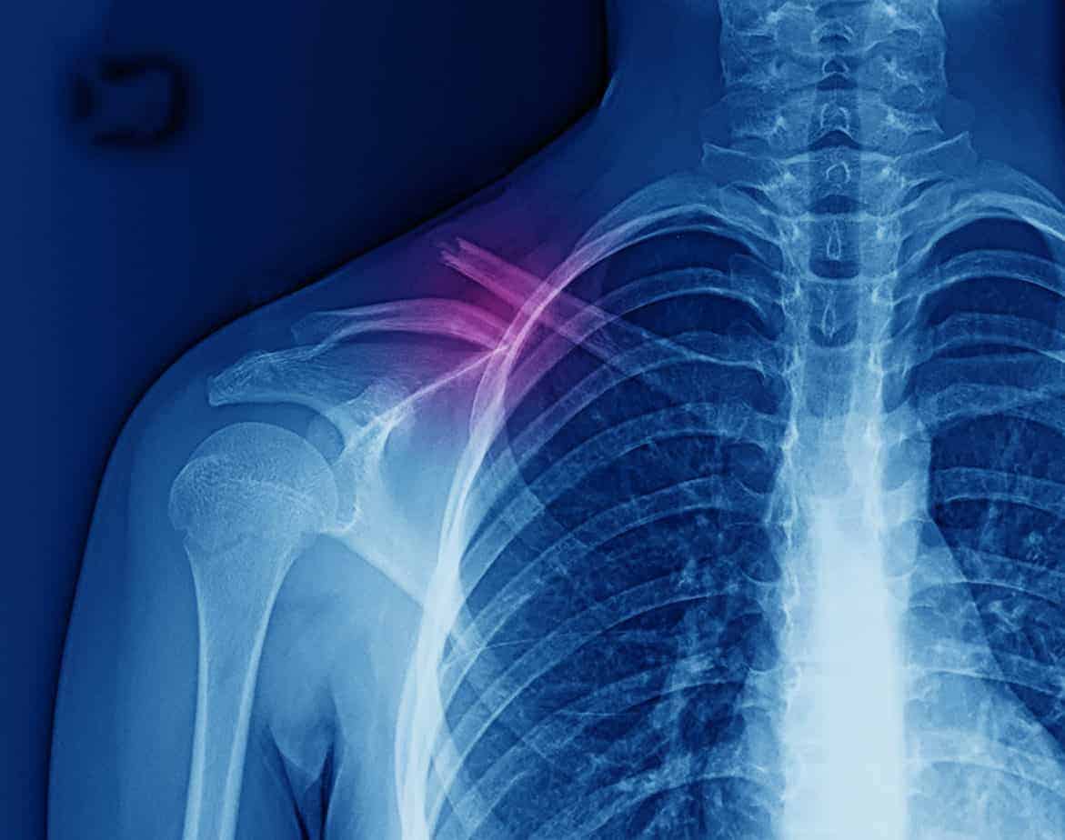 https://aica.com/wp-content/uploads/2019/07/What-To-Expect-When-Expecting-Shoulder-Surgery-AICA-Orthopedics-scaled.jpg