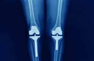 Knee Revision 101 | AICA Orthopedics