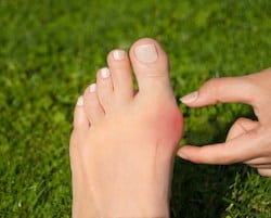 Foot with a bunion requiring an orthopedic Atlanta doctor