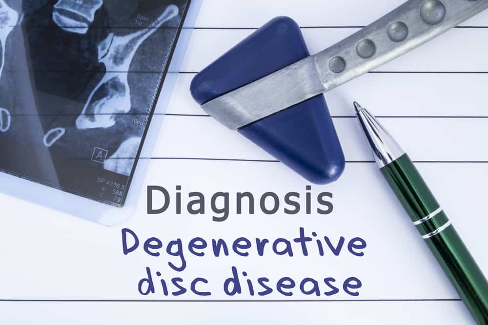 Degenerative Disc Disease: Everything You Need to Know