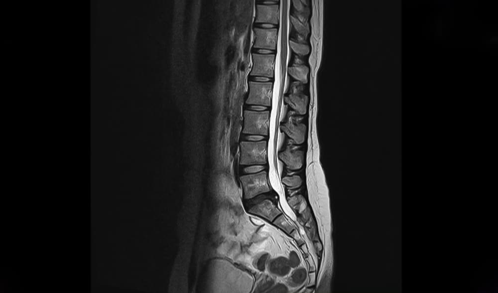 The Truth About Spinal Stenosis and Car Accidents - AICA Orthopedics