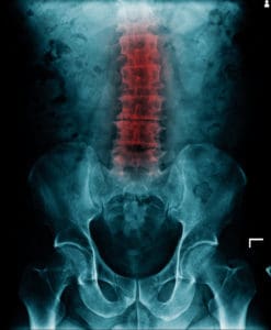 4 Ways to Prevent Degenerative Disc from Getting Worse