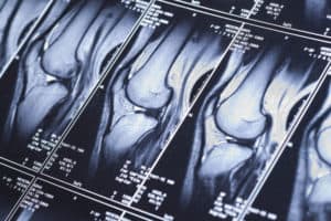 How Long Does a Knee MRI Take
