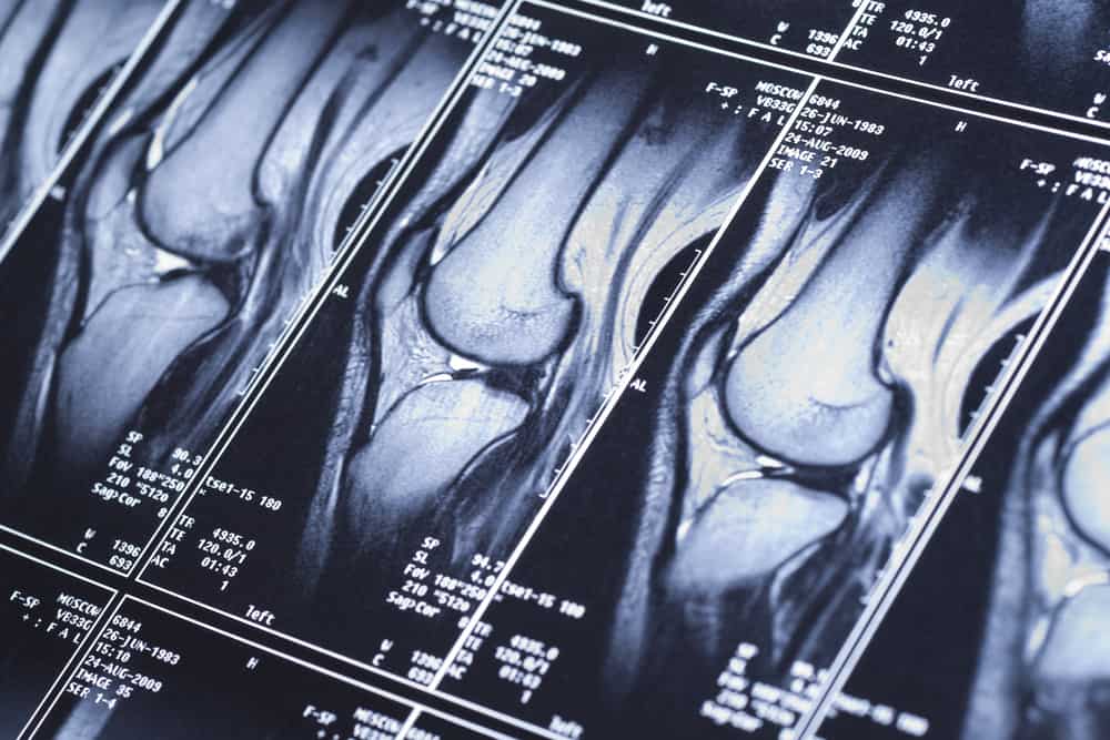 how to read mri images of right knee