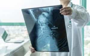 What Are My Treatment Options for Spinal Stenosis