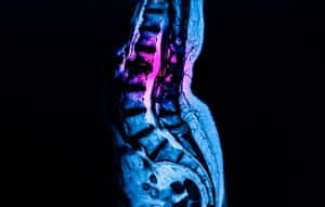 What Happens If Spinal Stenosis Goes Untreated